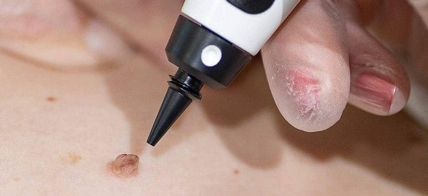 After Skin Tag Removal Uxbridge Moor