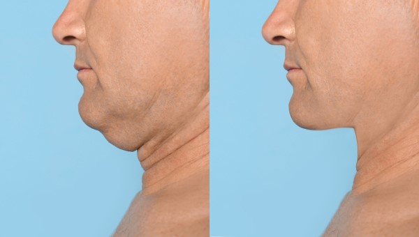Which Non-Surgical Treatments Work Best for Jowls and Loose Skin Uxbridge Moor?