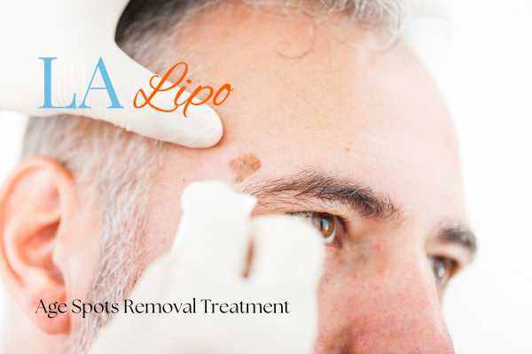 What Are the Most Effective Treatments for Age Spots Uxbridge Moor?