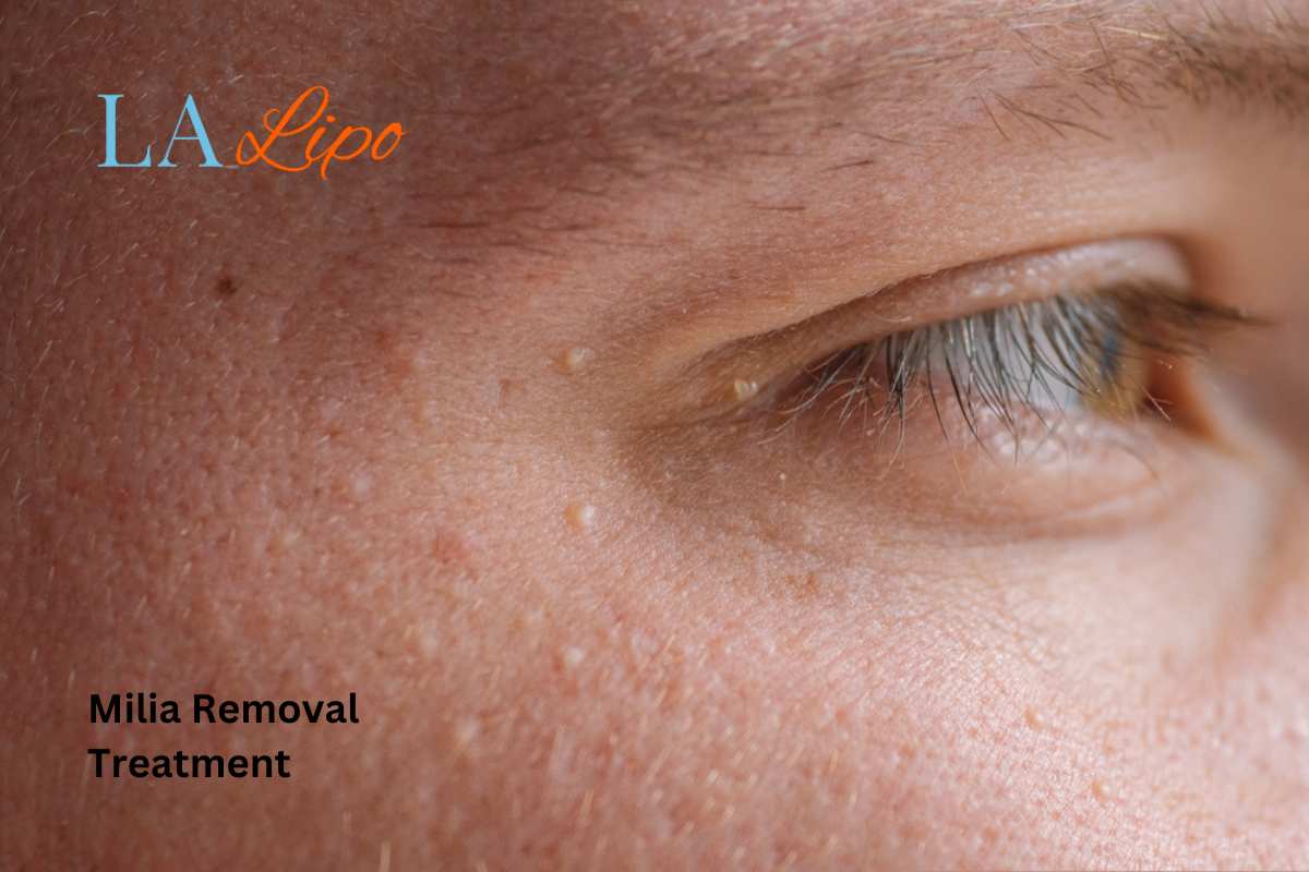 Cryopen Milia Removal: Is It the Easiest and Safest Option Uxbridge Moor?