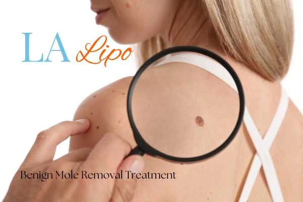 Woman having her inspection of blemish before mole removal Uxbridge Moor