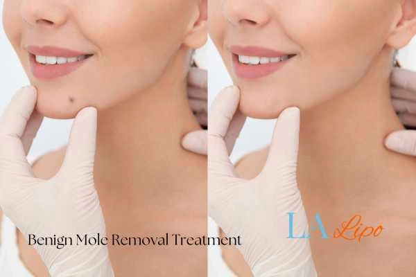 woman's before and after mole removal Uxbridge Moor results