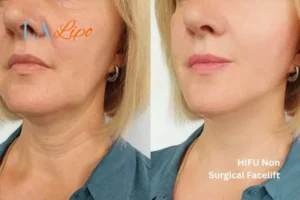 hi-fu for wrinkles Uxbridge Moor before and after results