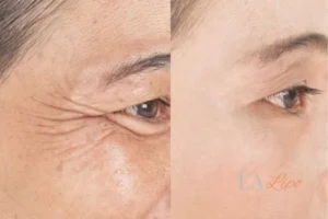 Before and after results of woman - HI-fu wrinkles reduction treatment Uxbridge Moor