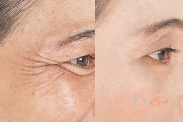 Before and after results of woman - HI-fu wrinkles reduction treatment Uxbridge Moor