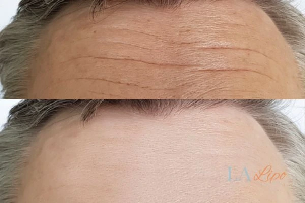 results of HIFU Uxbridge Moor on mans forehead to help reduce lines and wrinkles