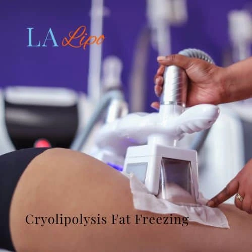 fat freezing - Cryolipolysis Uxbridge Moor
