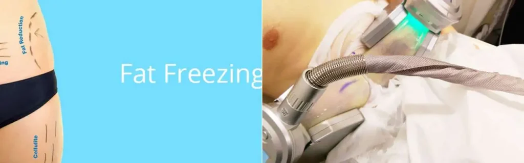 multi areas of a persons body having coolsculpting Uxbridge Moor treatment