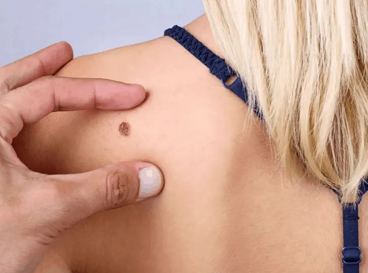 woman having mole removal Uxbridge Moor consultation before treatment.