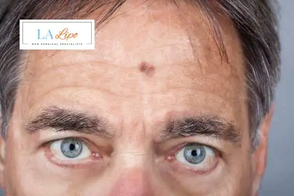 Solar Lentigo Removal Uxbridge Moor image of man with mark on his forehead
