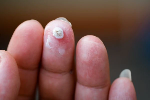wart on person finger - cryotherapy to treat from LA LIPO Uxbridge Moor