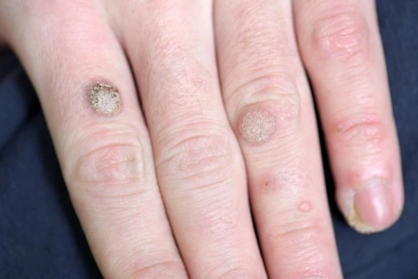 photo of warts on person hand - see wart removal Uxbridge Moor from LA LIPO