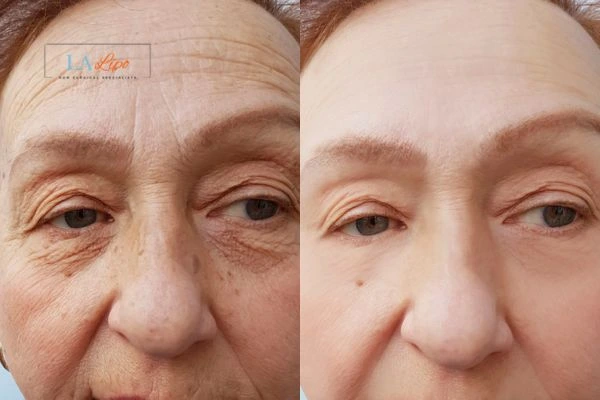 The powerful benefits of Morpheus8 Treatment Uxbridge Moor - Call Our team today!