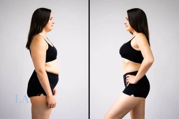Picture of womans before and after using LA-EMS body sculpting to improve her core strength Uxbridge Moor