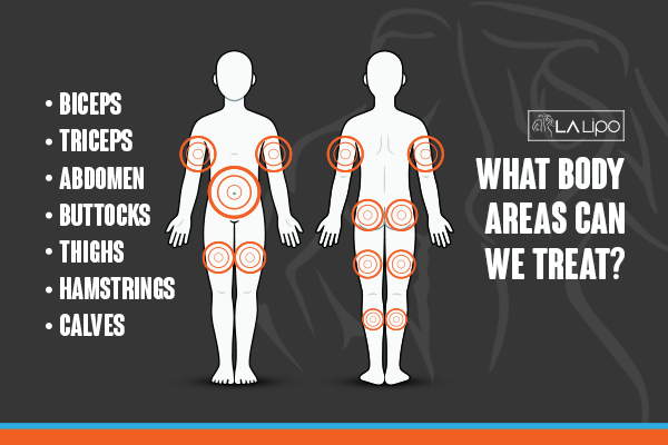 Diagram to show areas you can have LA-EMS Body Sculpting Treatment Uxbridge Moor
