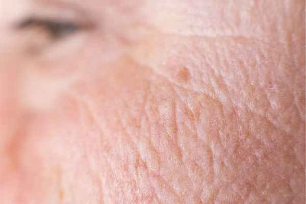 close up picture of a woman's face showing an age spot Uxbridge Moor
