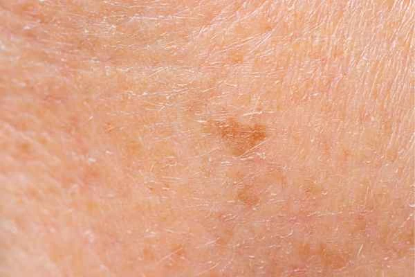 close up picture of age spots Uxbridge Moor