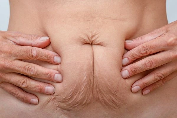 Image of a woman's stomach with loose skin - example of skin tightening Uxbridge Moor options
