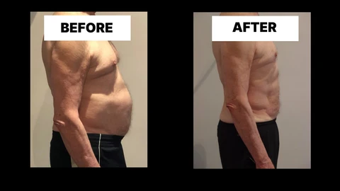 What Symptoms Can Diastasis Recti Cause in Men? Weak Core, Back Pain and Poor Posture Uxbridge Moor